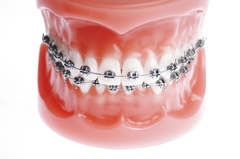 Here’s Why Clear Aligners are Ideal for Correcting Problematic Teeth